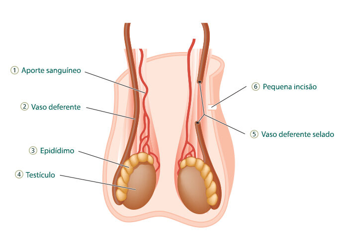 como funciona vasectomia em curitiba